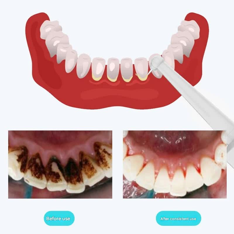 Ultrasonic Dental Scaler & Calculus Remover - 3 Modes, 2 Heads, LED Light(blue)