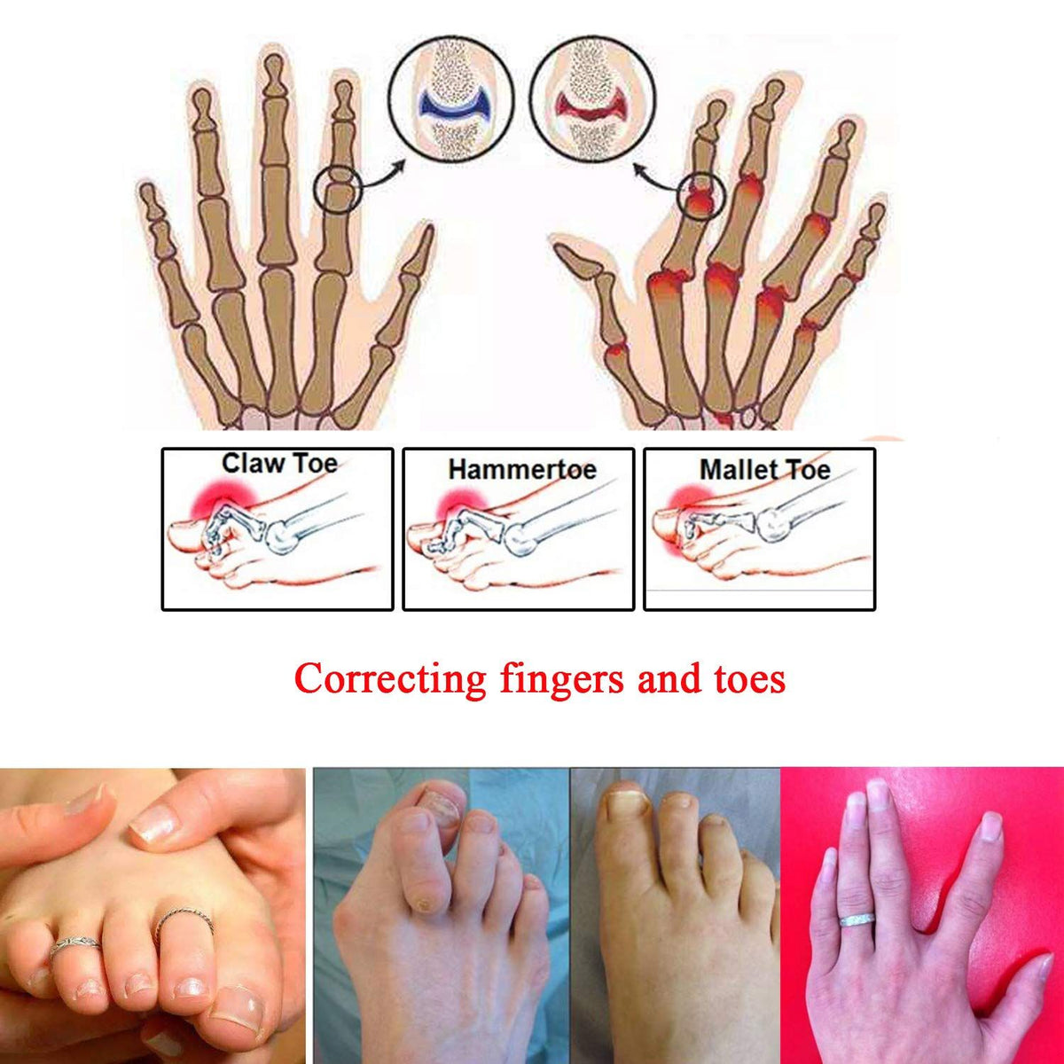 6 Pack Fabric Hammer Toe Correctors, Hammertoe Straightener, Reusable Toe Buddy Wrap Protective Broken Toe Wraps